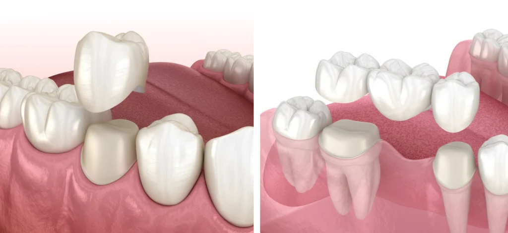 couronnes ponts traditionnel Traitements Cabinet du château - Dr Simon KOENIG