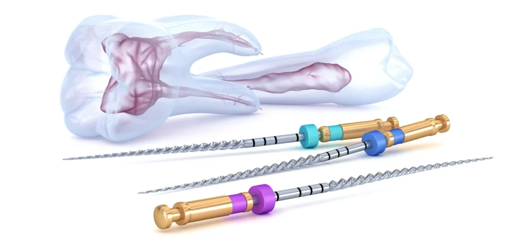 endodontie devitalisation Endodontie Cabinet du château - Dr Simon KOENIG