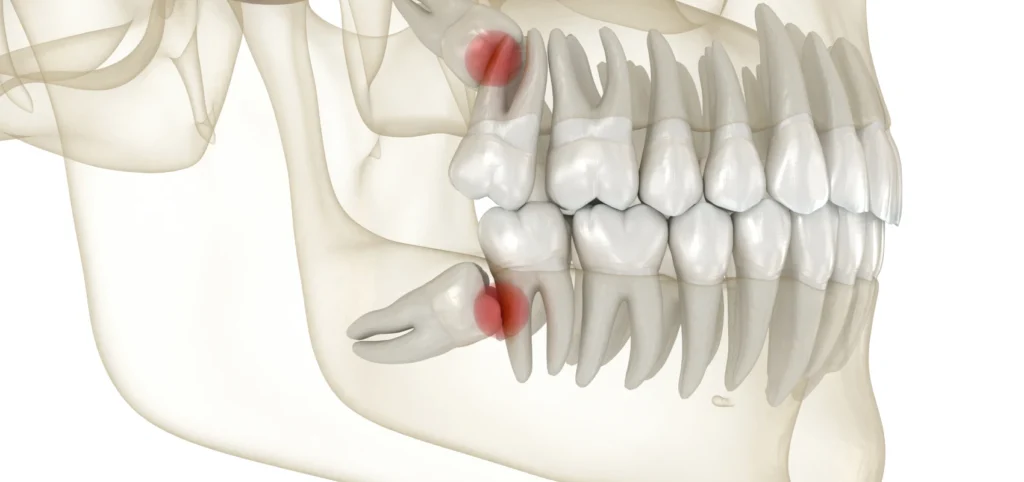 extraction dents sagesse dentiste gisors Traitements Cabinet du château - Dr Simon KOENIG