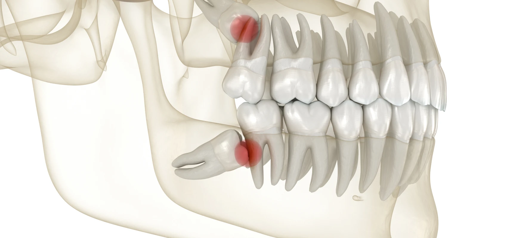 extraction dents sagesse dentiste gisors Extraction de dents de sagesse Cabinet du château - Dr Simon KOENIG
