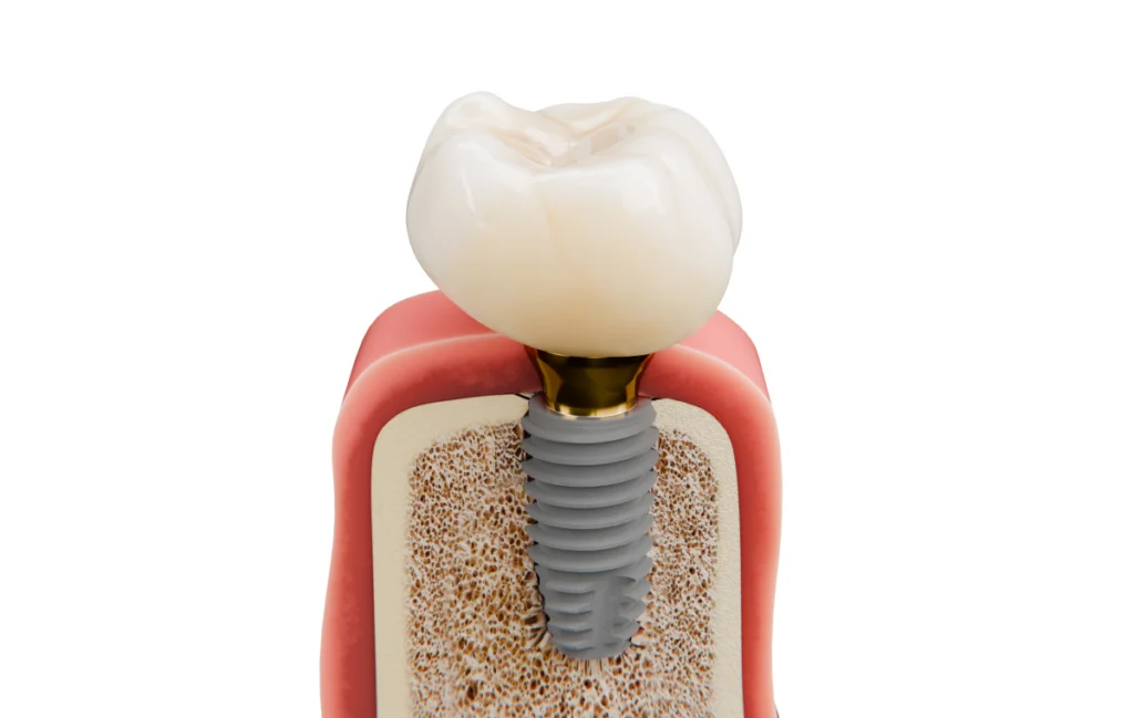 implant dentaire etrepagny Dentiste à Étrépagny : implants dentaires Cabinet du Château - Dr Simon KOENIG