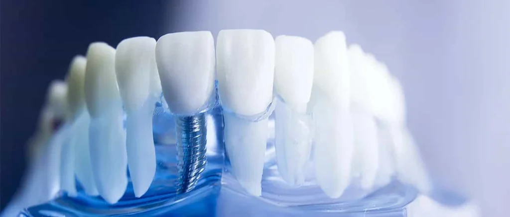 serofontaine implant dentaire serofontaine implant dentaire Dentiste à Sérifontaine : implants dentaires Cabinet du Château - Dr Simon KOENIG