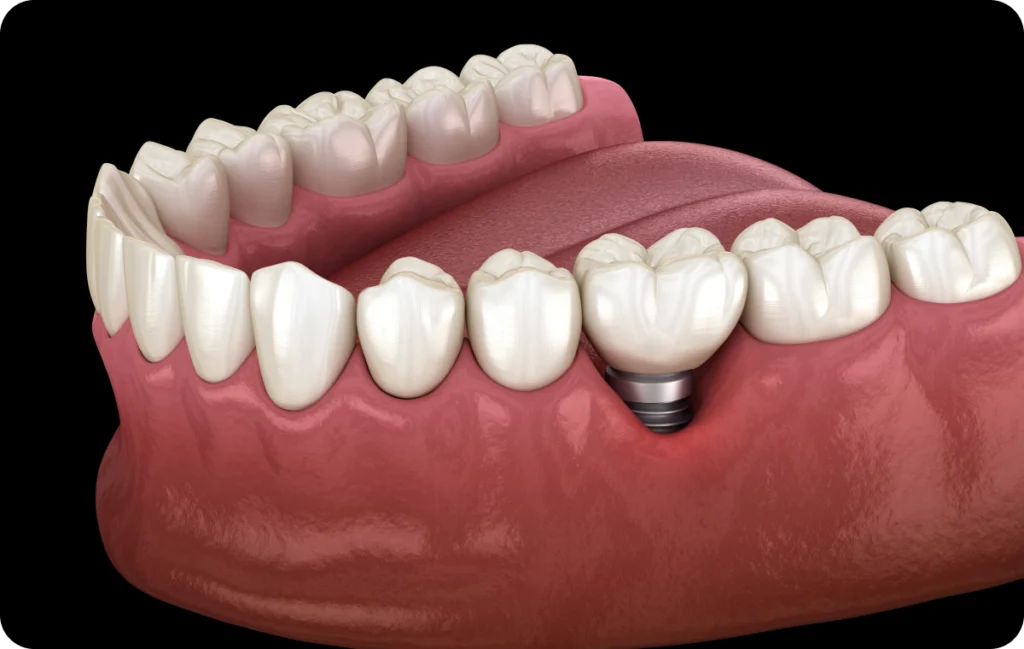 implant dentaire gournay en bray Dentiste à Gournay-en-Bray : implants dentaires Cabinet du Château - Dr Simon KOENIG