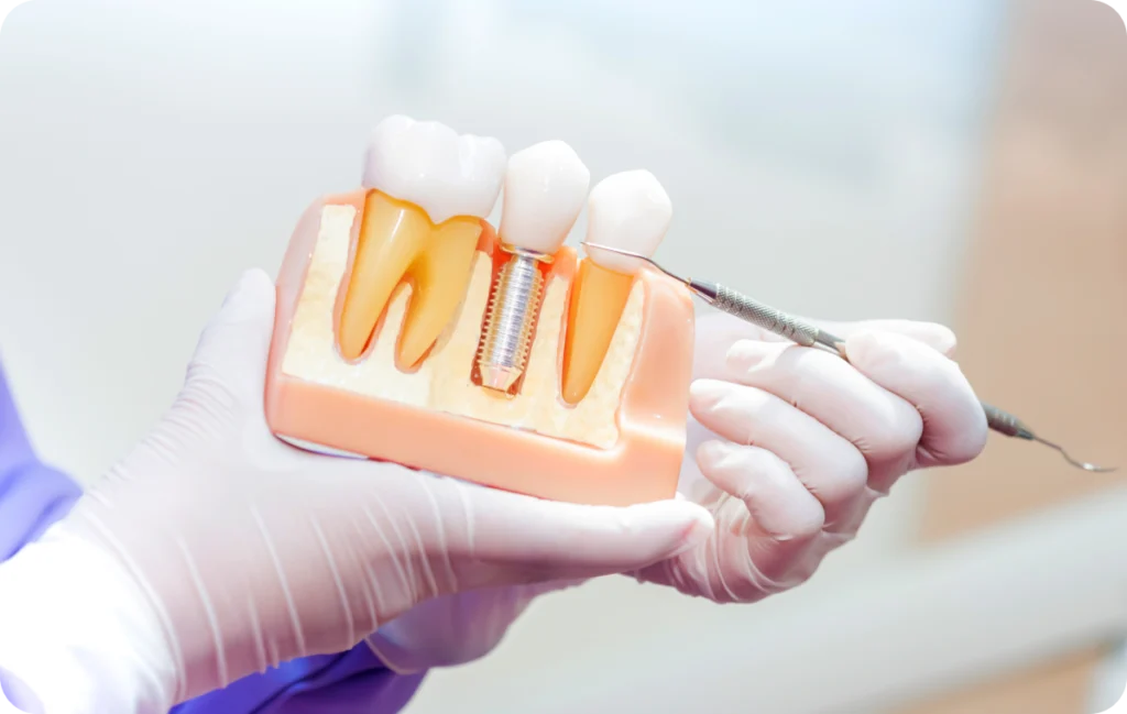 pose couronne implant dentaire gournay en bray Dentiste à Chaumont-en-Vexin : implants dentaires Cabinet du Château - Dr Simon KOENIG