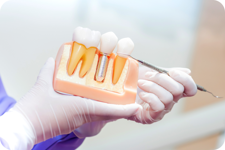 dentiste beauvais implants dentaires Dentiste à Beauvais : implants dentaires Cabinet du Château - Dr Simon KOENIG