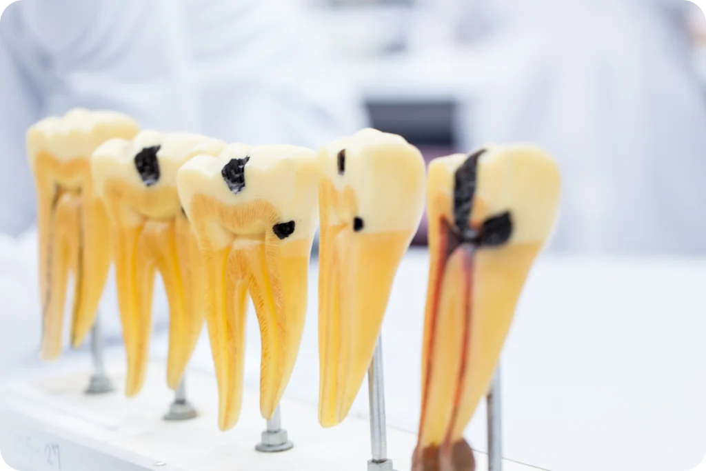rdv dentiste fleury sur andelle caries Dentiste à Fleury-sur-Andelle Cabinet du Château - Dr Simon KOENIG