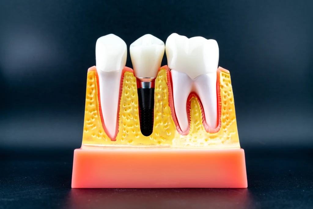rdv dentiste fleury sur andelle implant dentaire Dentiste à Fleury-sur-Andelle Cabinet du Château - Dr Simon KOENIG